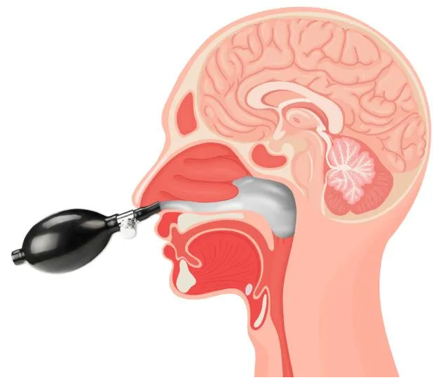 Dr. Petrie performing a Cranial Facial Release treatment with an endonasal balloon