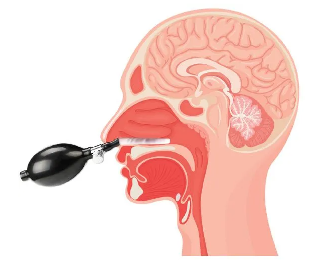 Cranial Facial Release medical balloon and blood pressure bulb prepared for treatment
